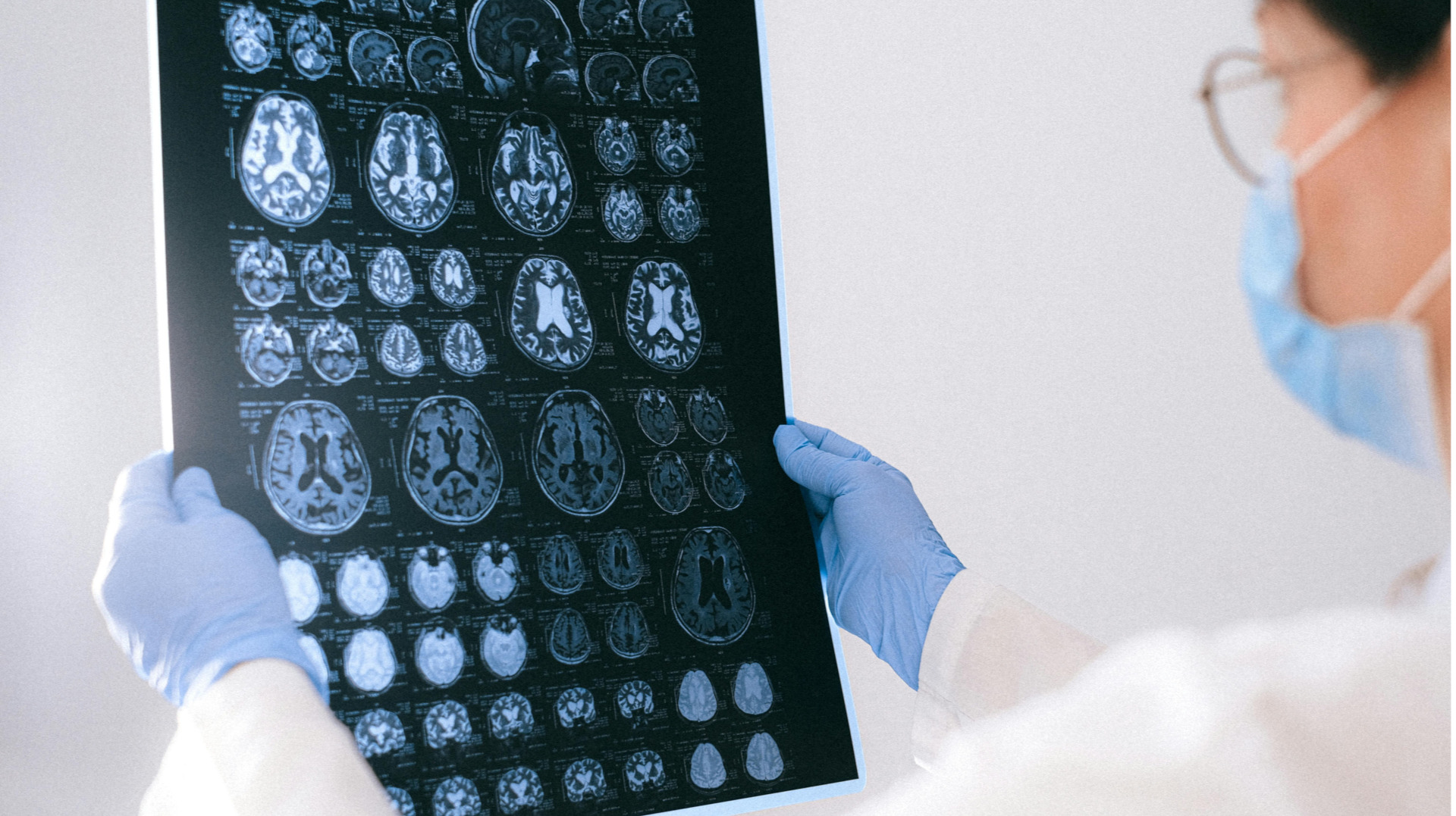 Les novetats en el diagnòstic i el tractament de la malaltia d’Alzheimer